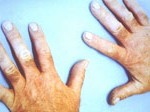 Vibration White Finger